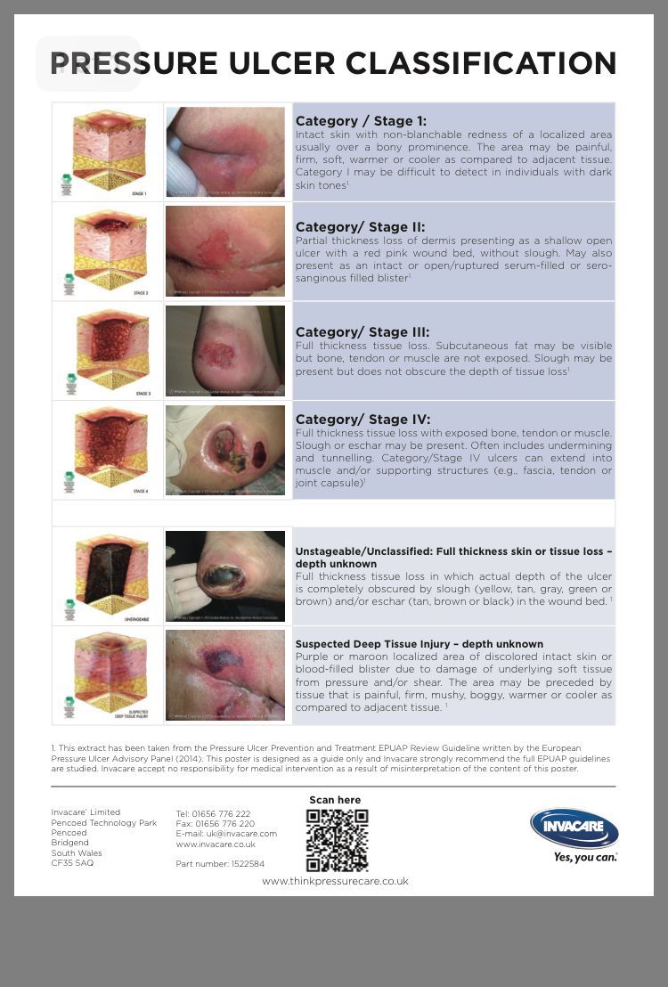 Chart Pressure Ulcer Staging Guide