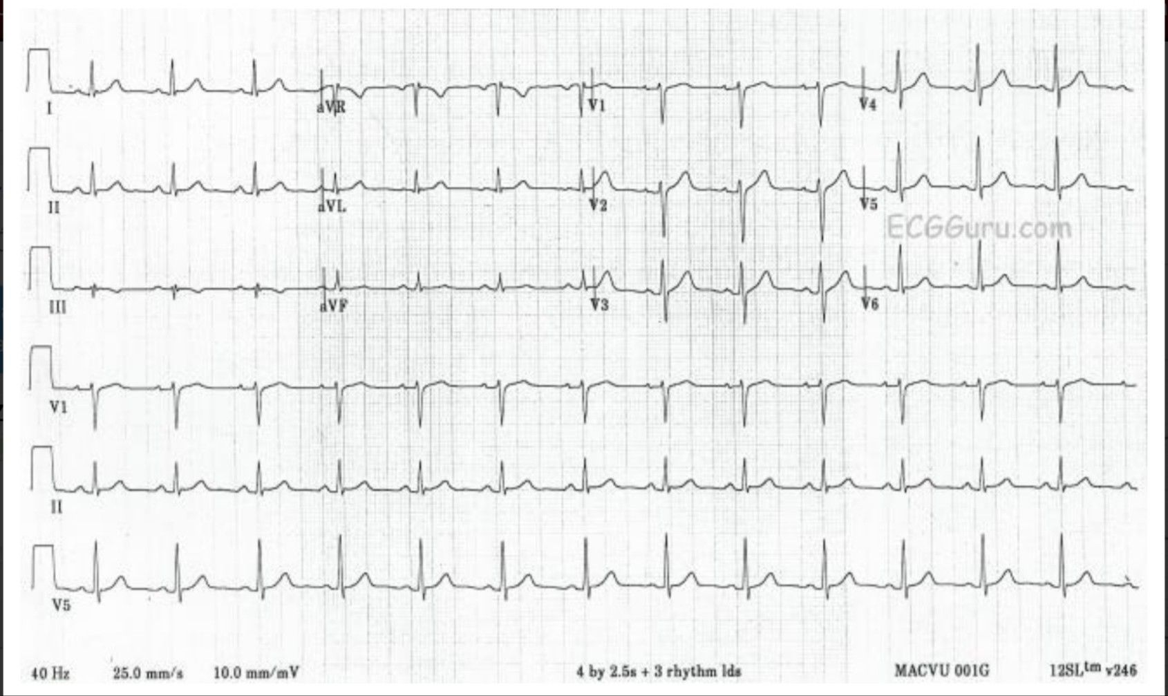 Normal ECG Normal Ecg, Normal Sinus Rhythm, Qrs Complex, Pr Interval, P ...