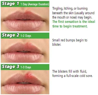 Cold Sores On Lips Early Stages