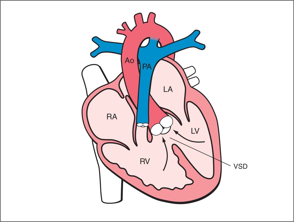 Tetralogy of Fallot, Pulmonary Atresia with Ventricular Septal Defect ...