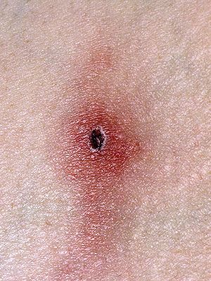 Tick Bites Symptoms | Tick Bites | Pinterest | Tick bite, Ticks and ...