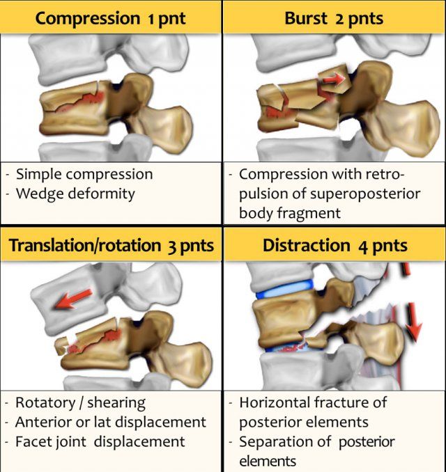 Types Of Spinal Fractures Radiology - Design Talk