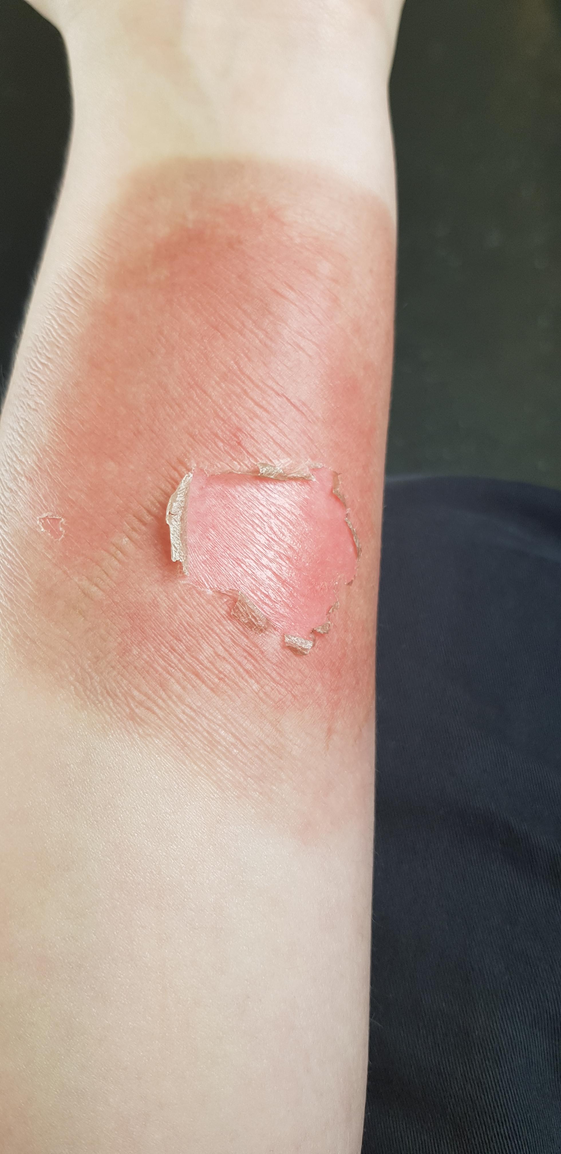 2nd Degree Burn Healed