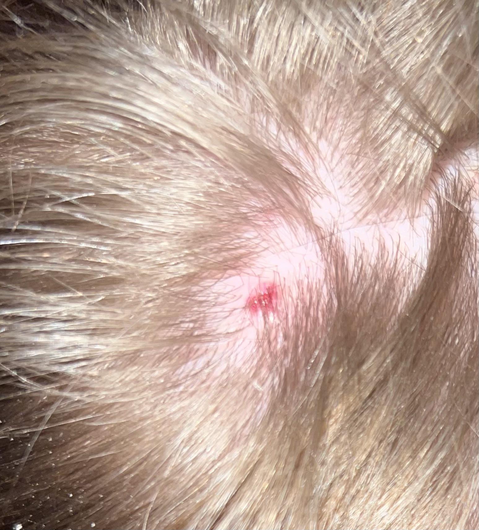 Scalp has this really red bump, kind of itchy, please help : r/Melanoma