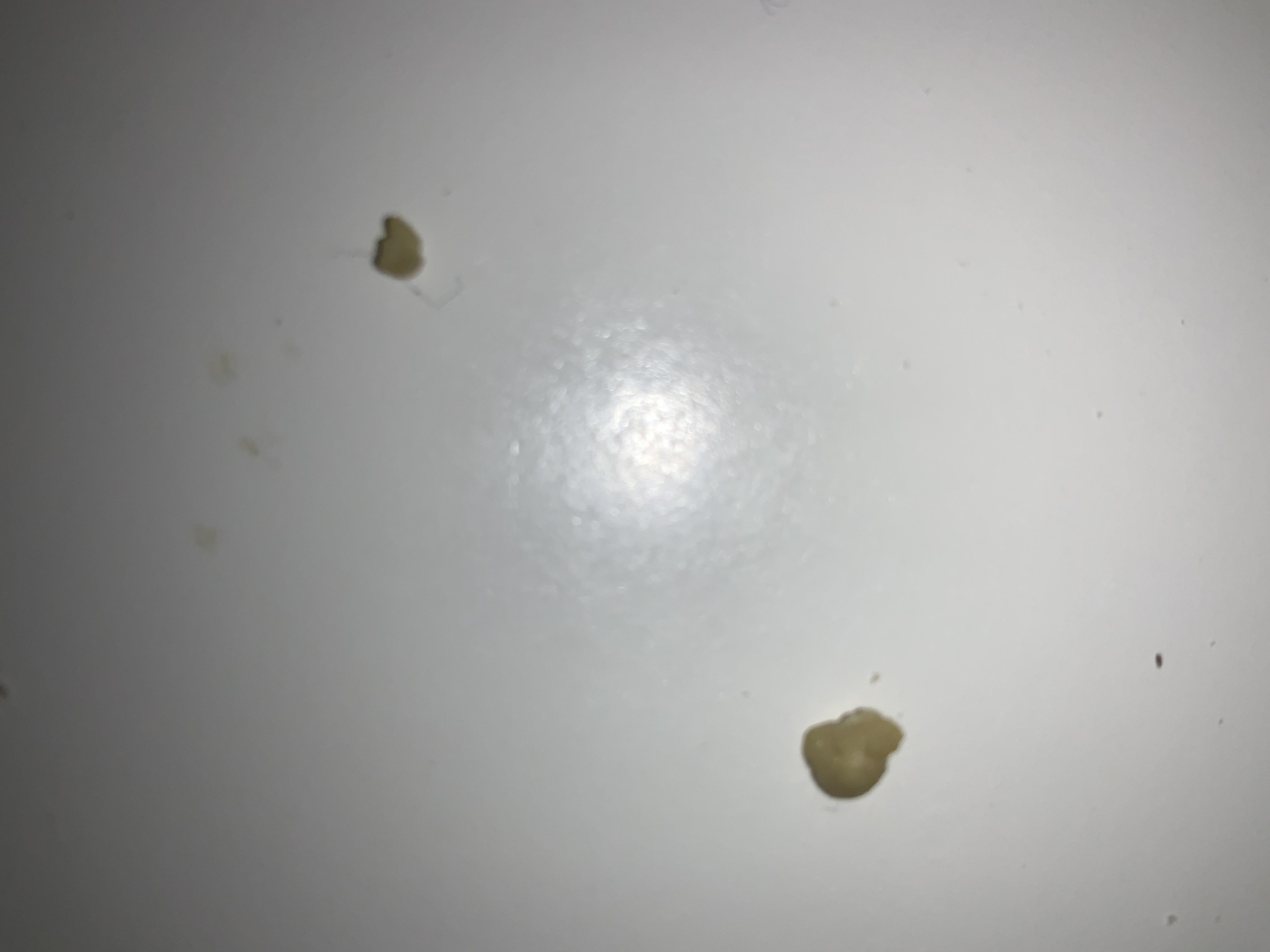 So these are tonsil stones?? Are these any concern or just annoying and ...