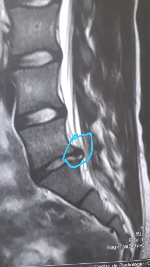 Is my disc ruptured or bulged ? And wich is worse?... : r/AskDoctorSmeeee