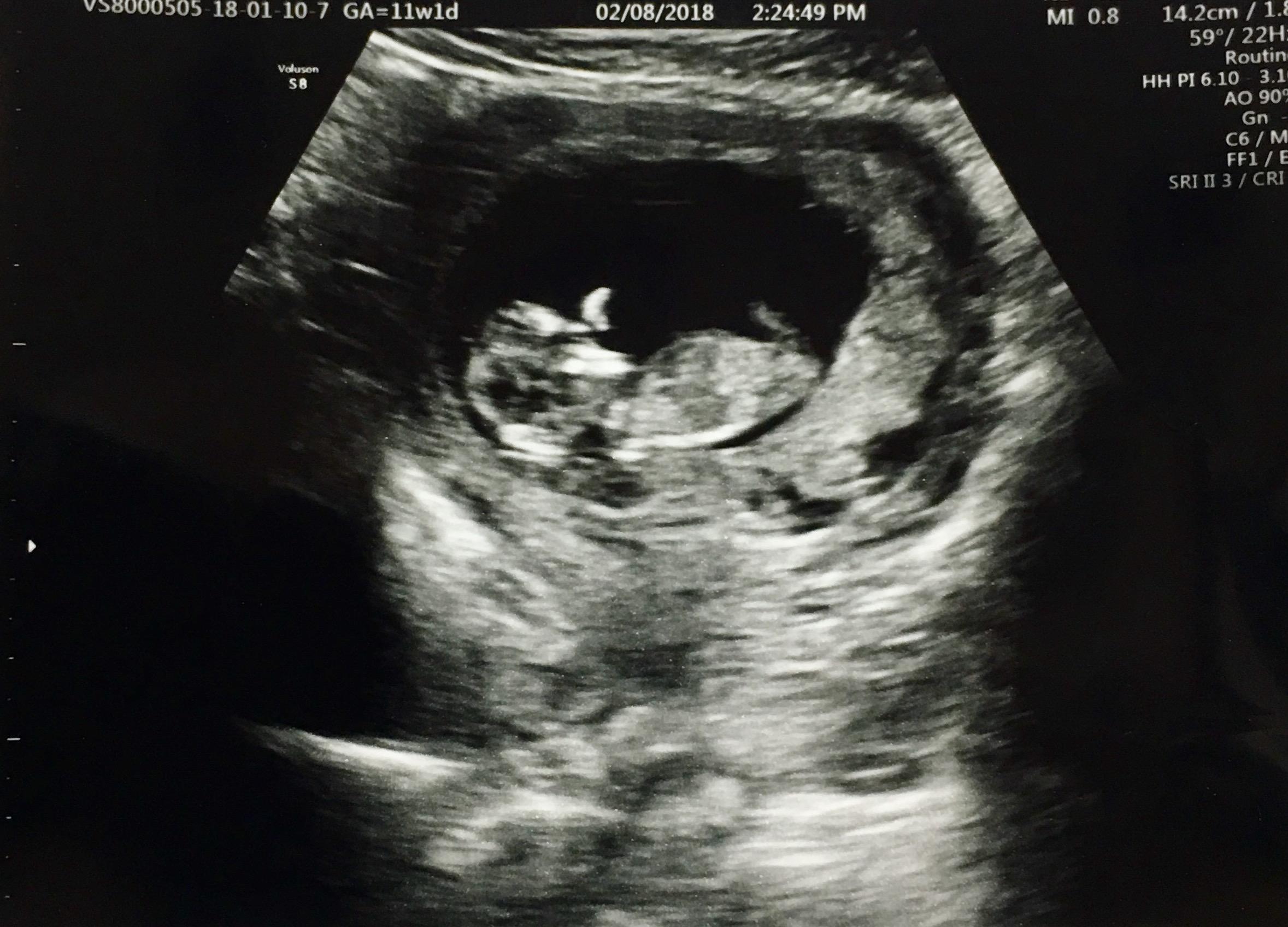 11 Week Ultrasound Pictures