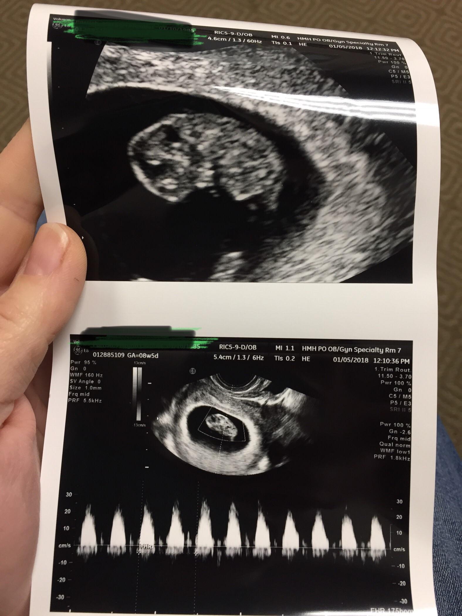 8 Week Ultrasound Heartbeat