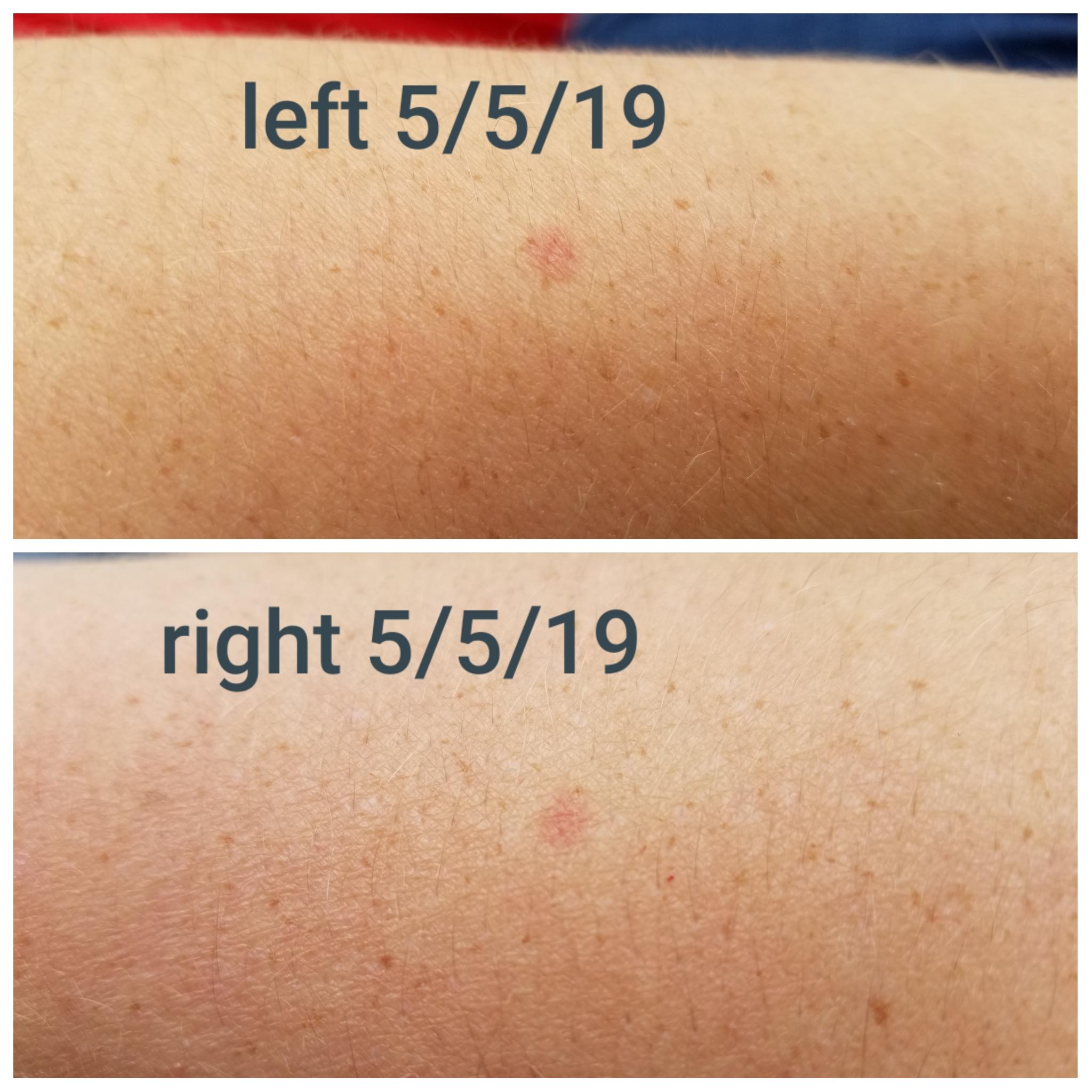 Pinpoint red dots on skin arm - hotelssilope