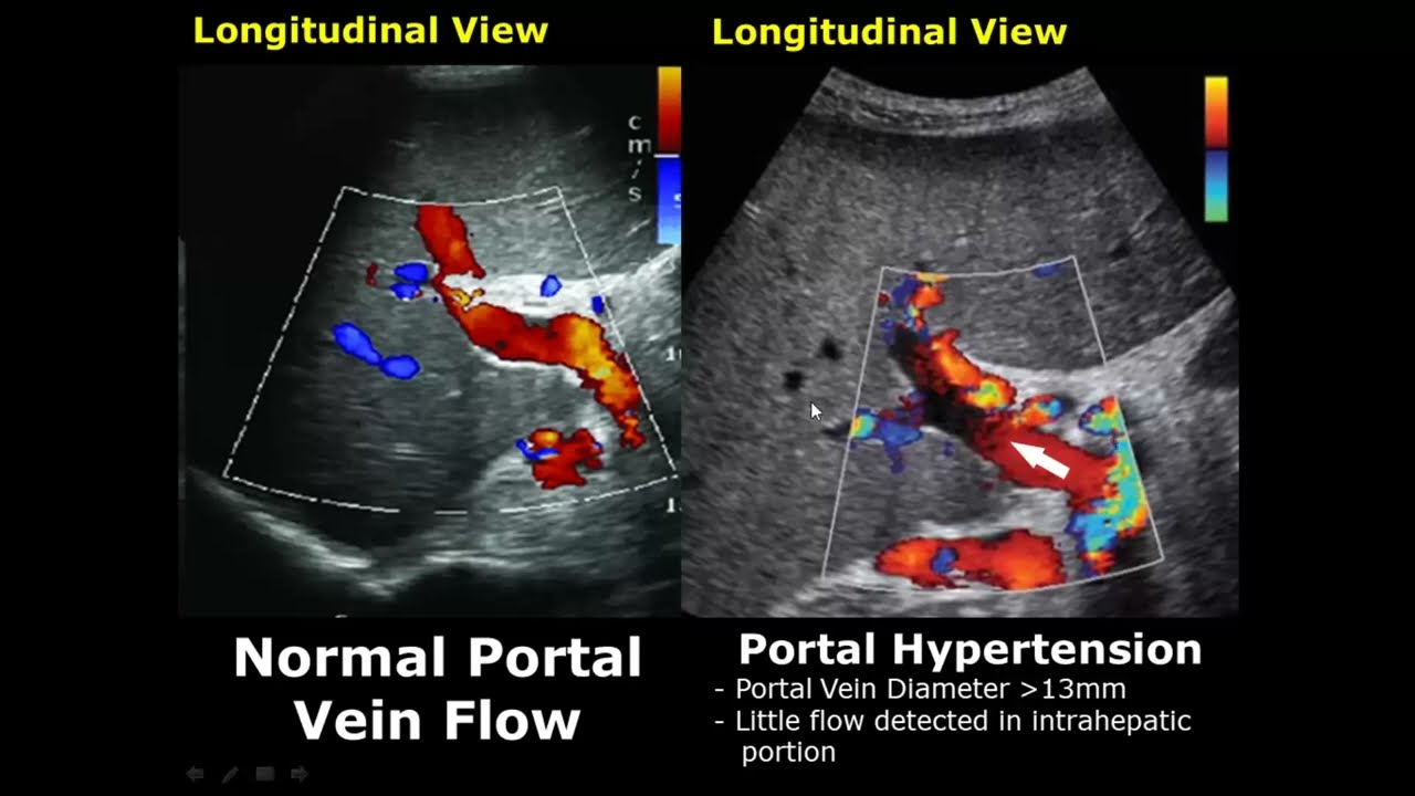 Normal Liver Ultrasound