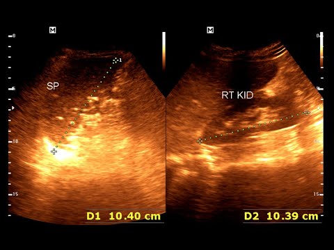 Splenic Granuloma | Leiomyoma uterus | Abdominal sonography - YouTube