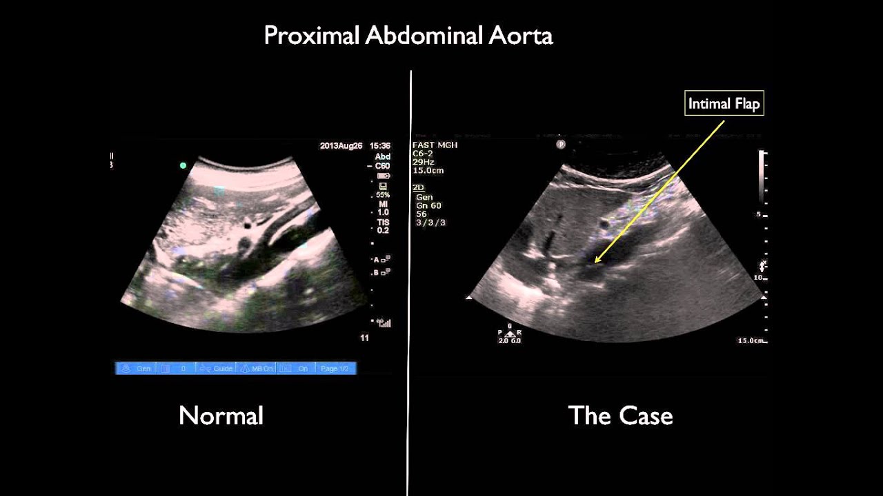 Ultrasound Abdominal Aorta Anatomy