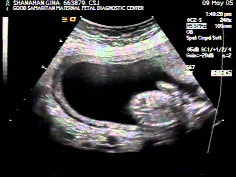 Ultrasound Pictures Of Identical Twins