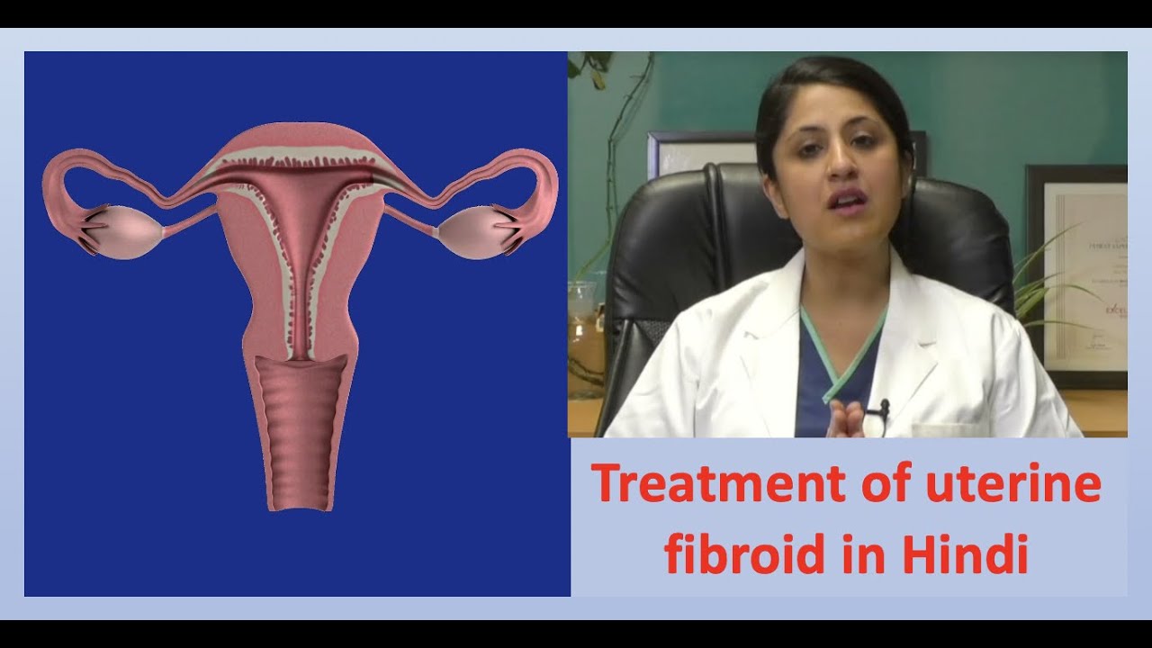 Uterus Fibroid : Symptoms, treatment, management in Hindi, Dr Kanika ...