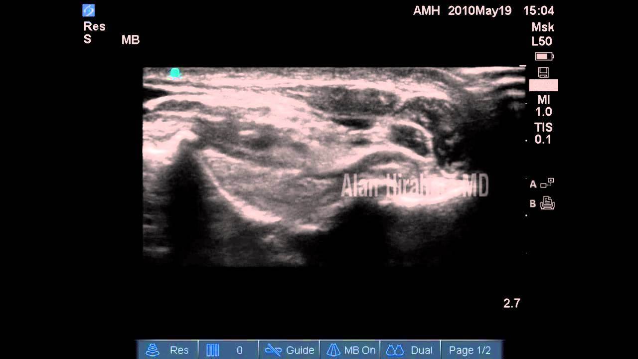 Elbow Joint Ultrasound