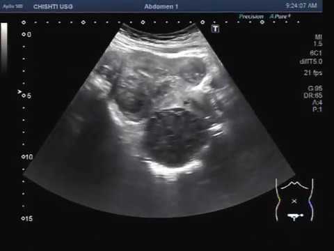 Uterus Fibroid Ultrasound