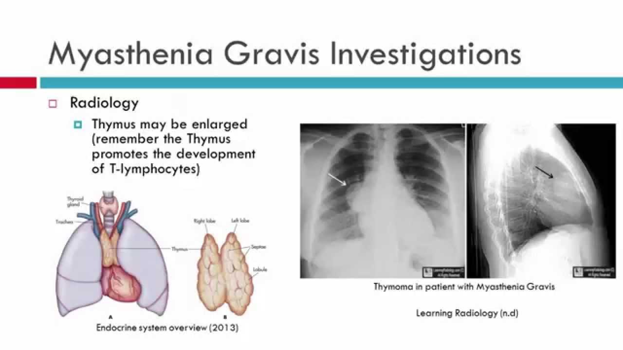 Pathophysiology Of Myasthenia Gravis