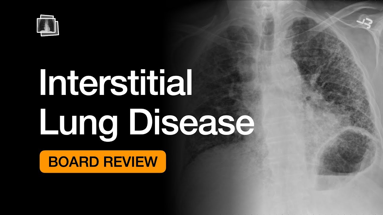 Interstitial Lung Disease | Chest Radiology Board Review - YouTube