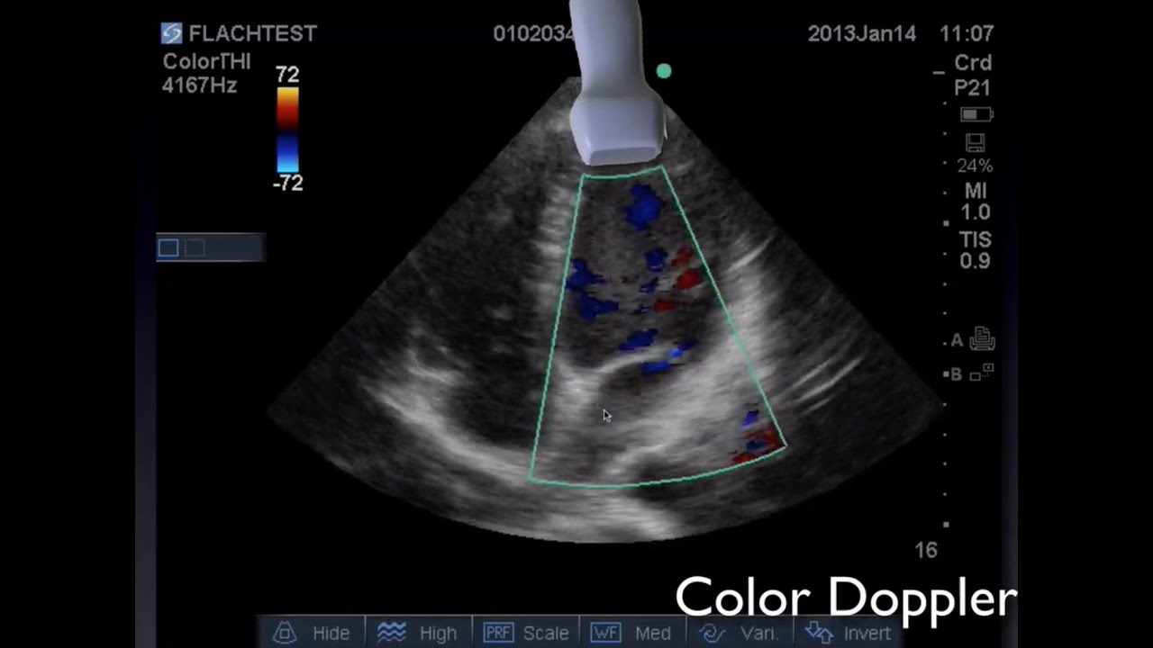 Cardiac Ultrasound - YouTube