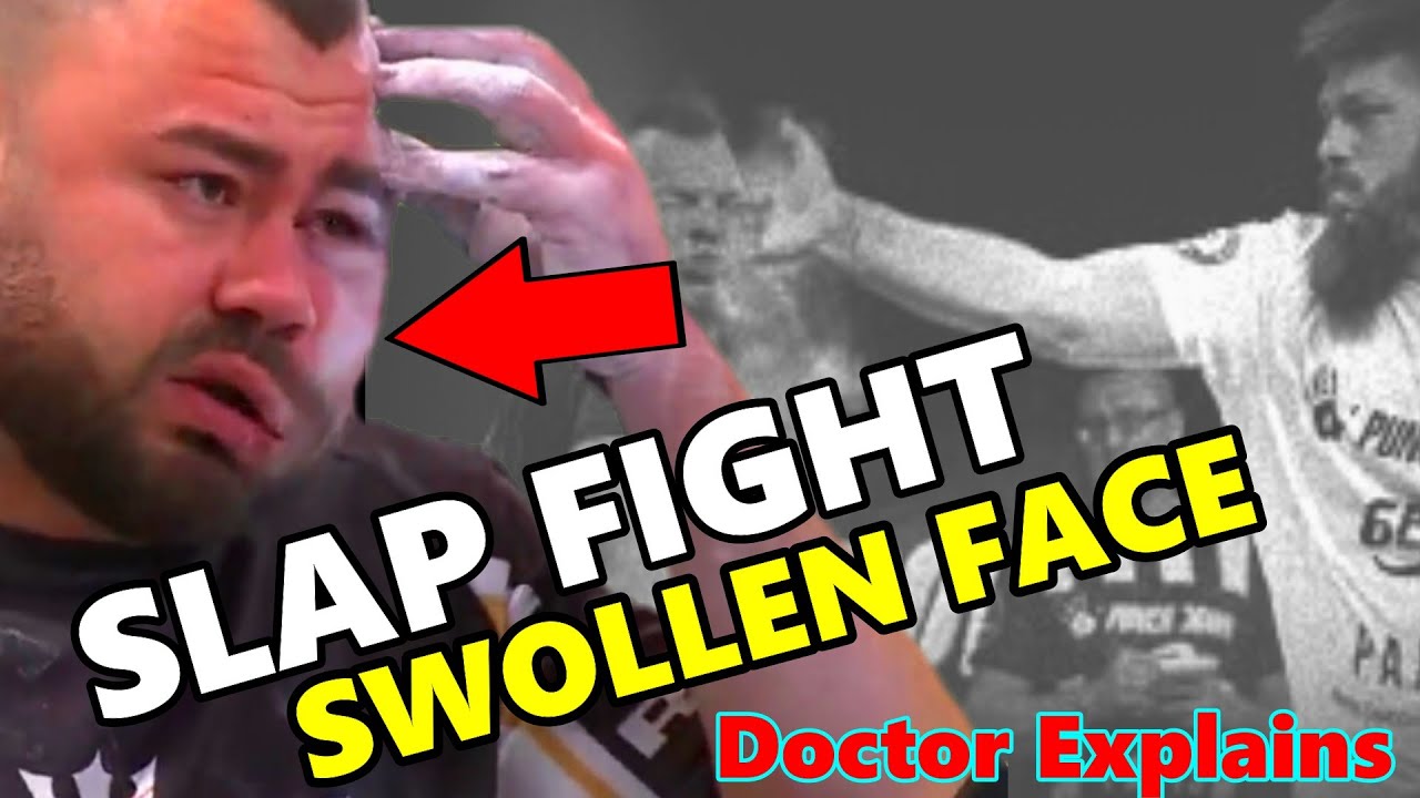 Slap Fight Horrific Injury: Doctor Reacts and Explains - YouTube