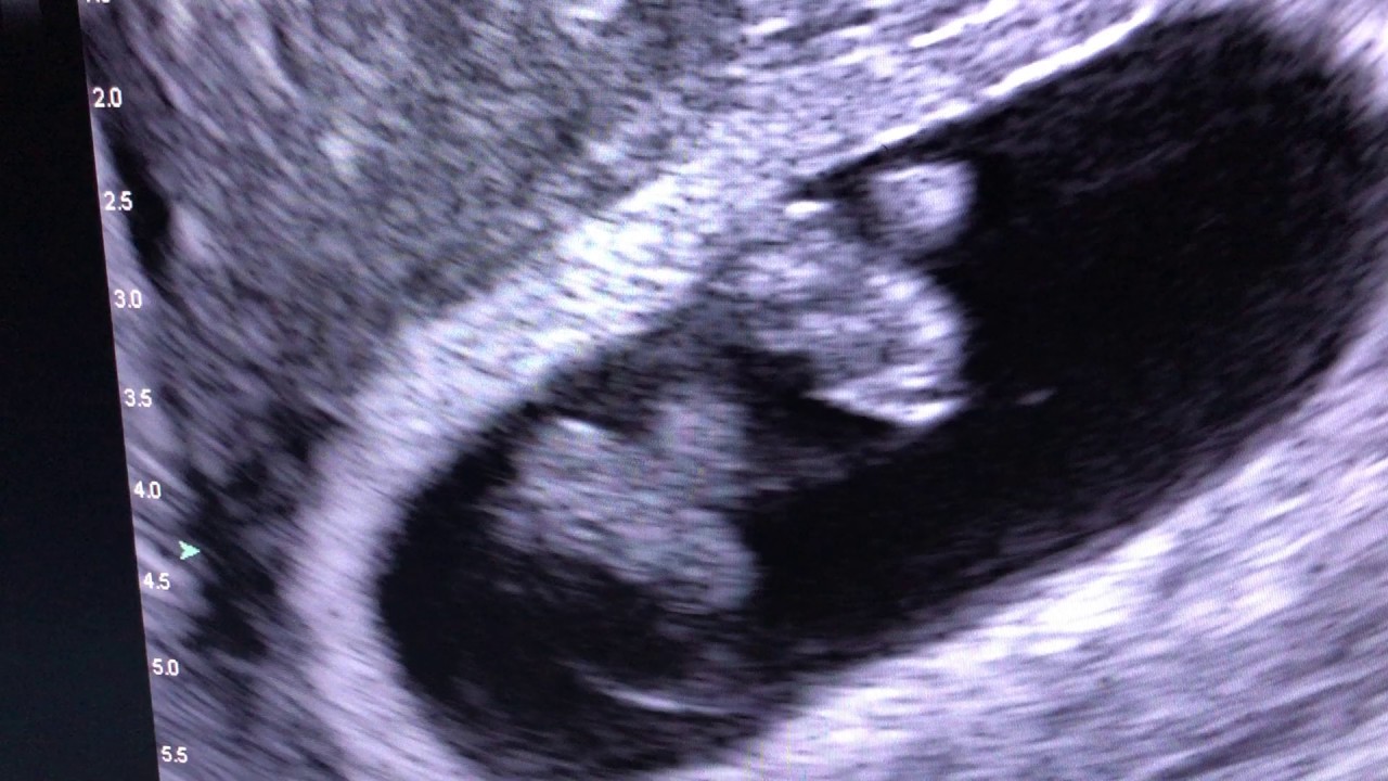 Twin Ultrasound 8 Weeks