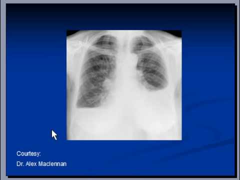 Chest x-ray -- Pleural effusion, Pneumonia - YouTube