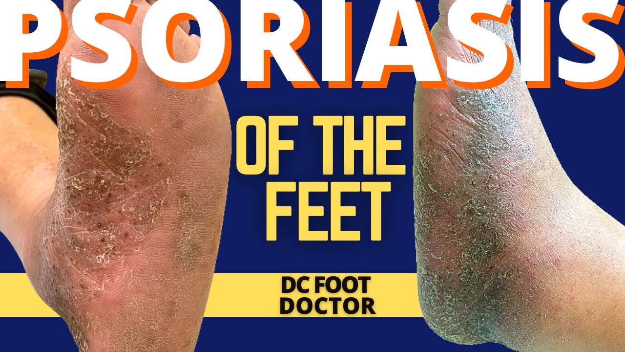 Psoriasis On Top Of Feet