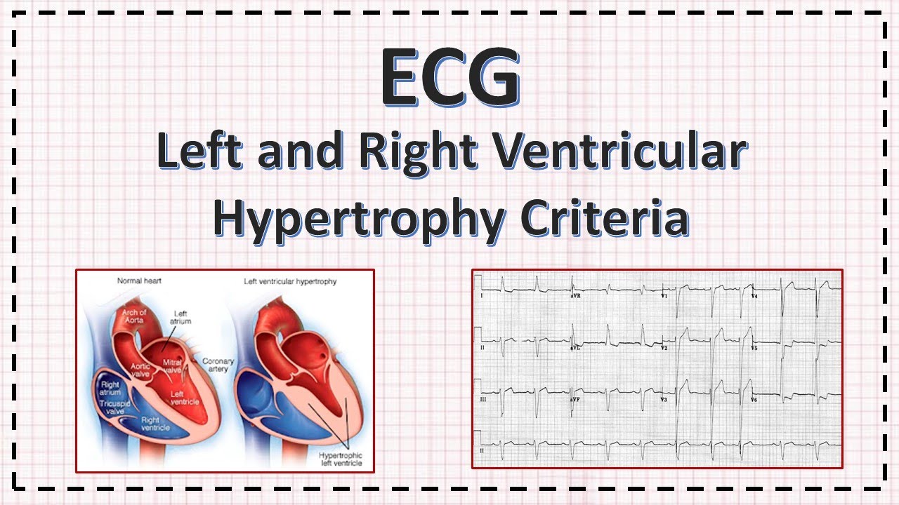 Right Ventricular Hypertrophy ECG Criteria