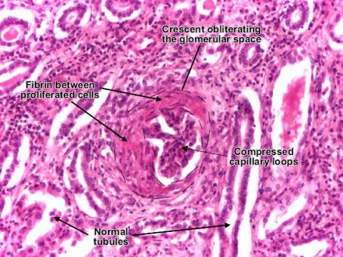 Rapidly Progressive Glomerulonephritis (RPGN) - YouTube