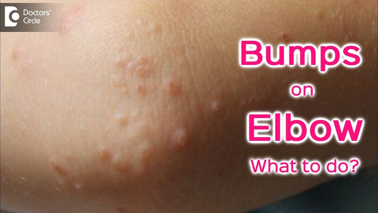 Raised Itchy Bumps On Elbows