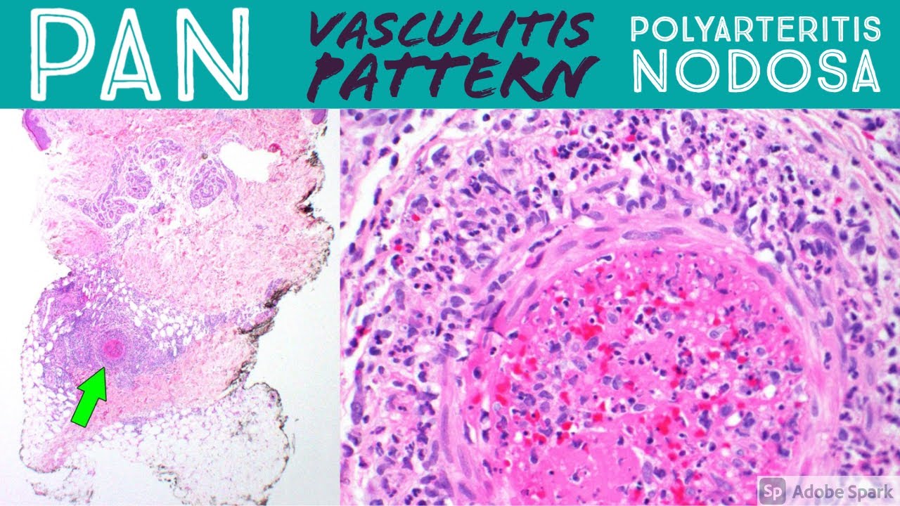 Leukocytoclastic Vasculitis Histology