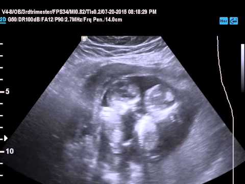 12 Week Ultrasound Pictures Twins