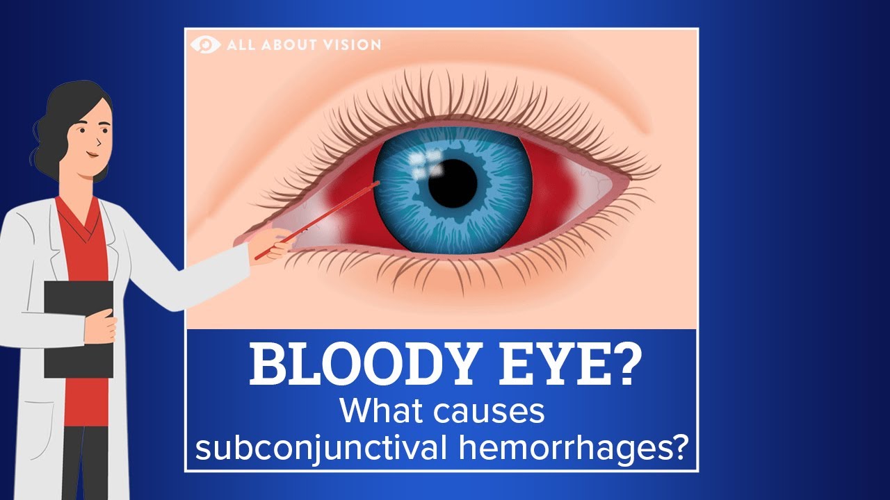 Subconjunctival Hemorrhage (Blood In Eye) Causes Treatment