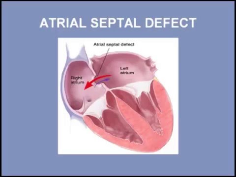 Atrial Septal Defect vs Ventricular Septal Defect - YouTube