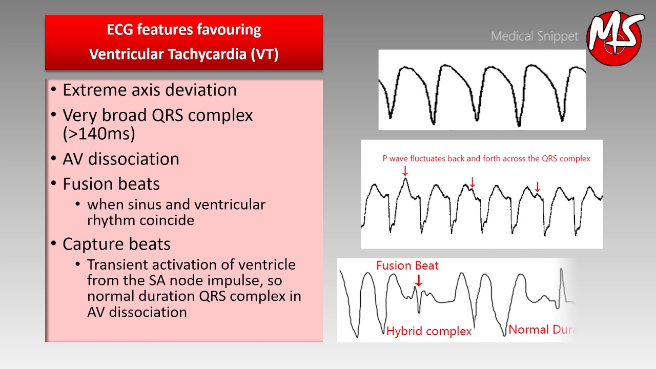 Ventricular Tachycardia Vs Supraventricular Tachycardia