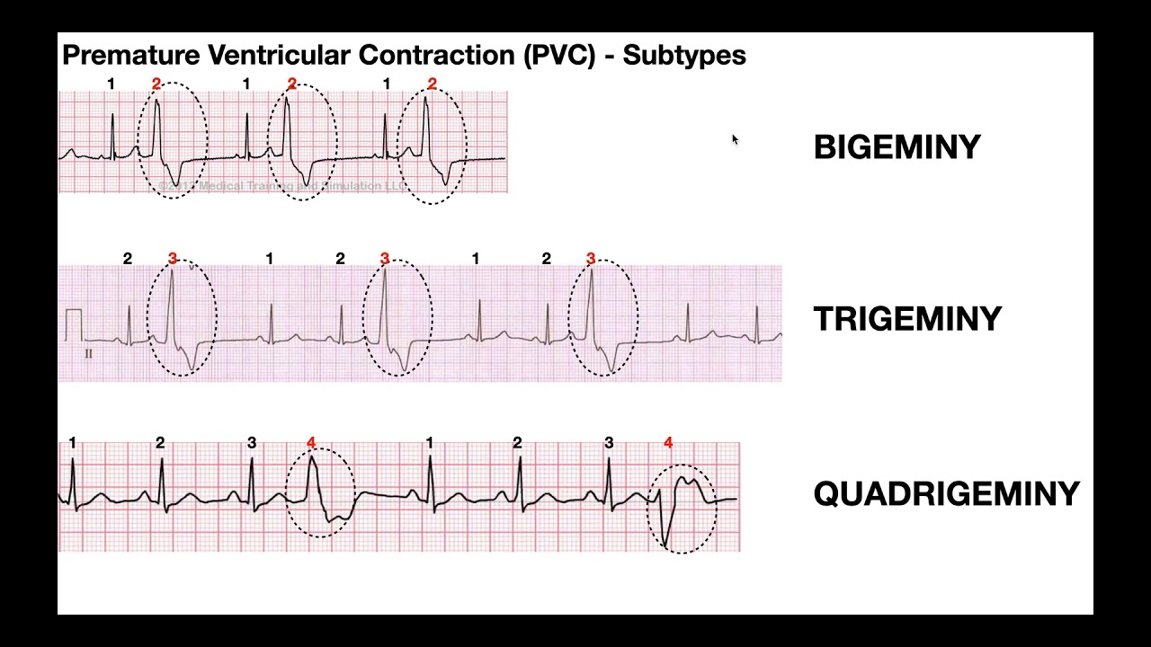 Premature Ventricular Contractions Causes