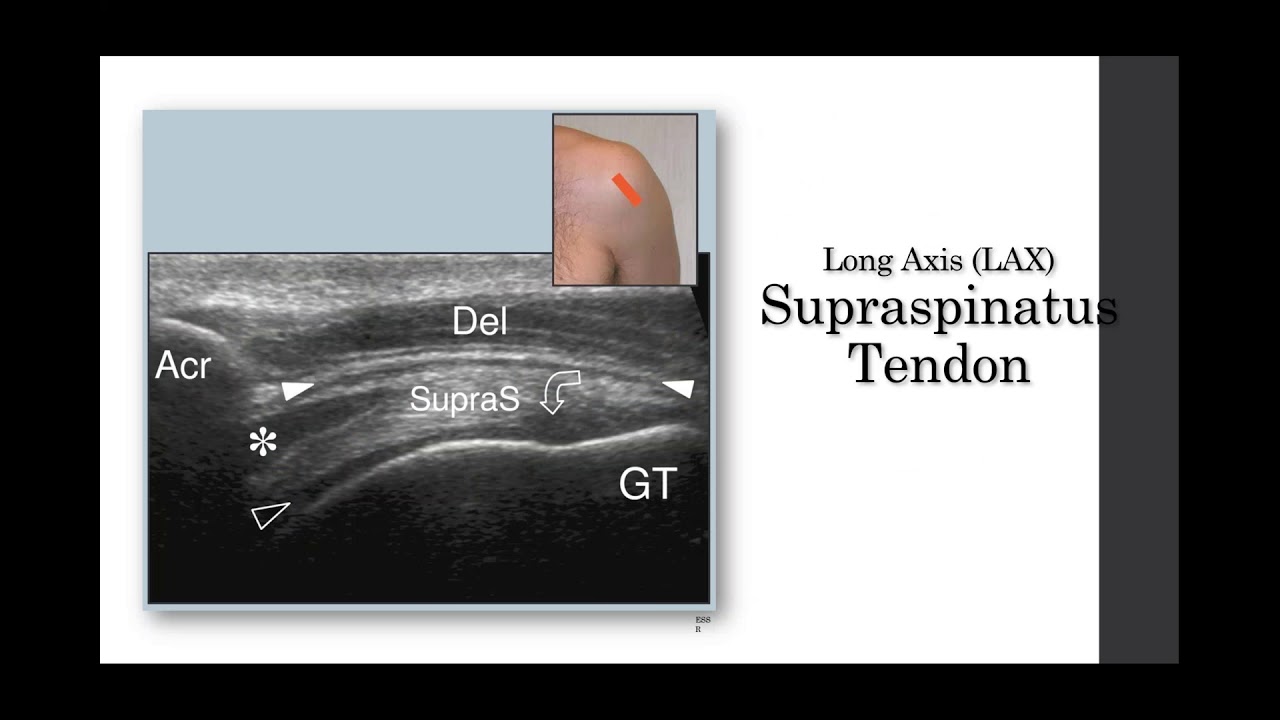 Rotator Cuff Injury Msk Medbullets Step 1