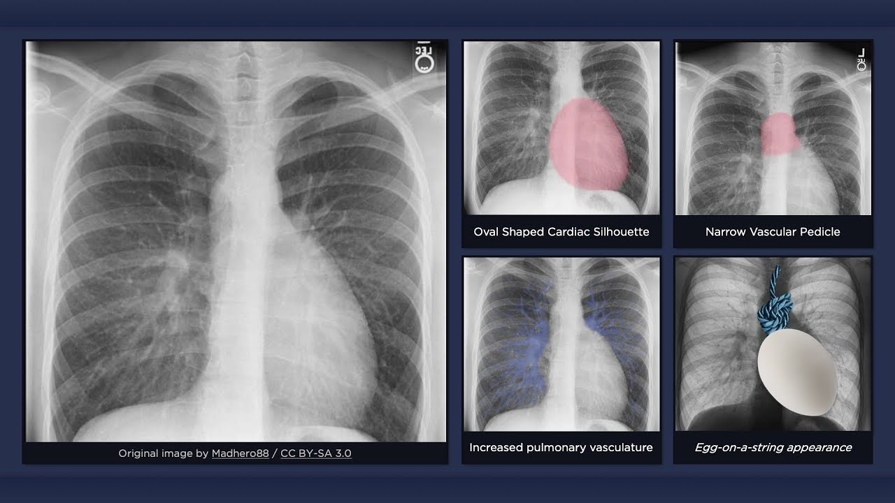 Transposition Of The Great Arteries X Ray