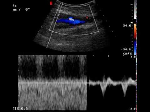 COMMON FEMORAL ARTERY- COMMON FEMORAL VEIN FISTULA. - YouTube