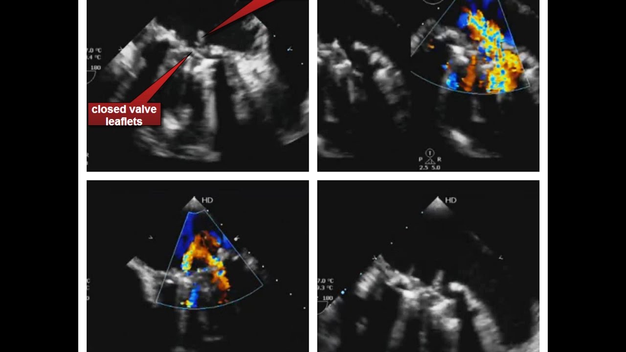 Infective Endocarditis Tee