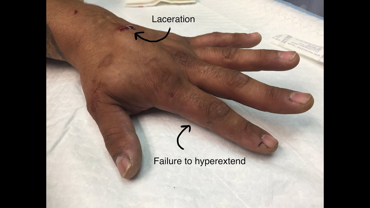 Repair of extensor Tendon CPT code - simplify medical coding - YouTube