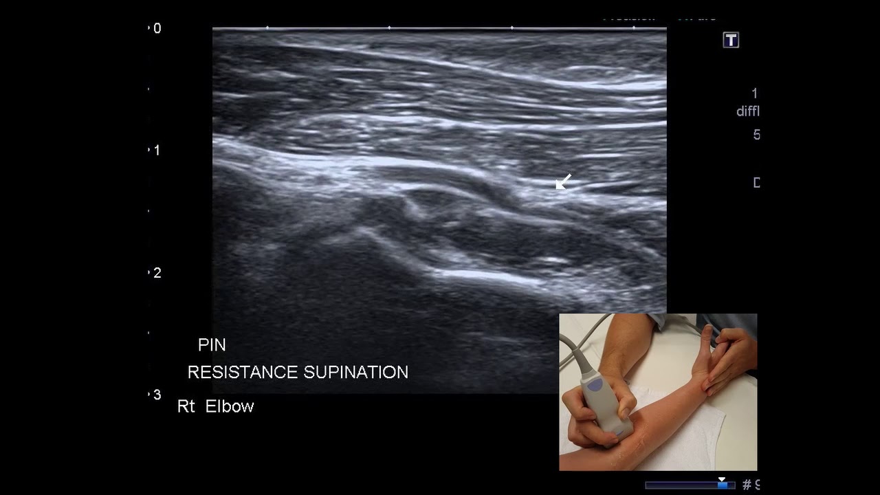 Radial Nerve Entrapment Elbow