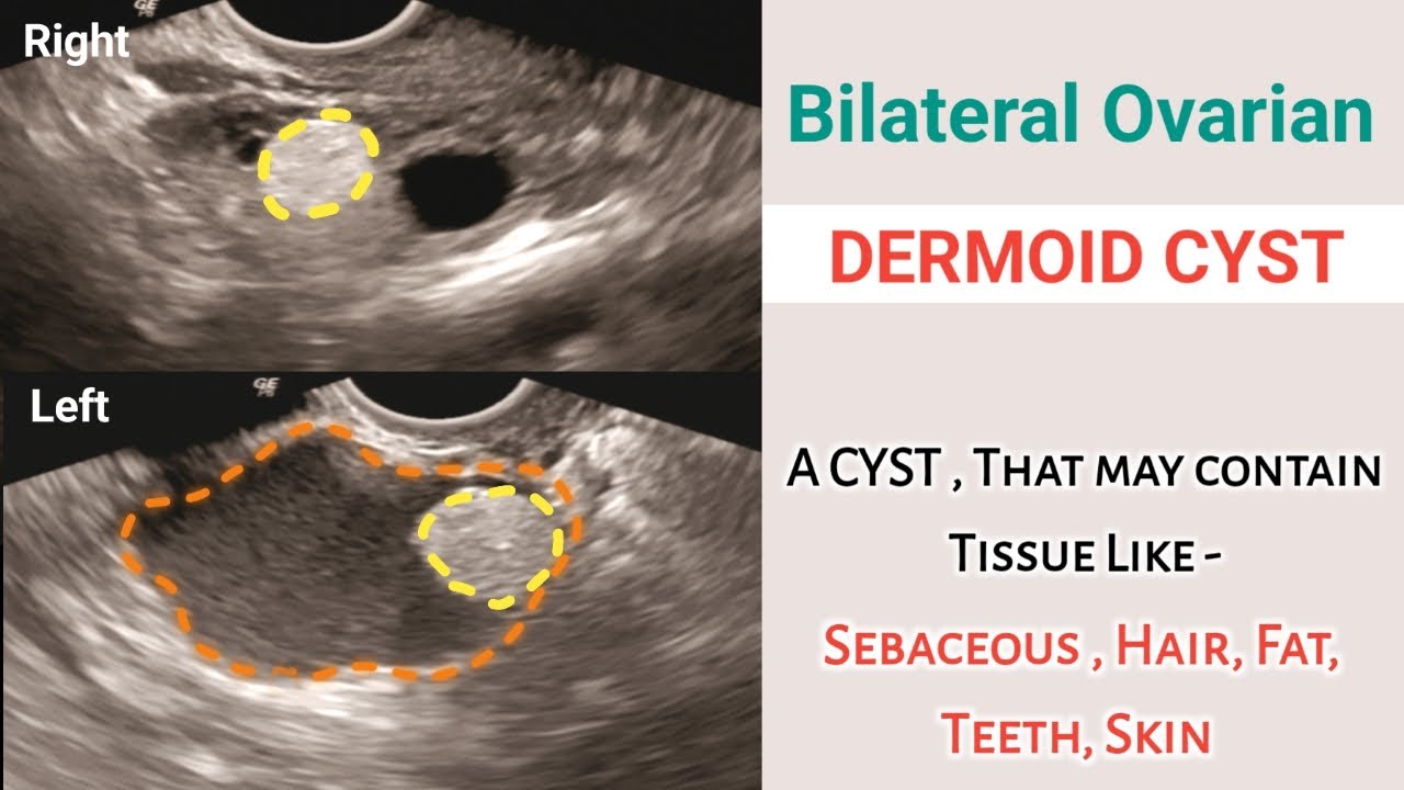 Bilateral Ovarian Dermoid Cyst | Treatment | Complications | Ultrasound ...