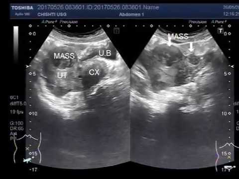 Uterine Fibroids On Ultrasound