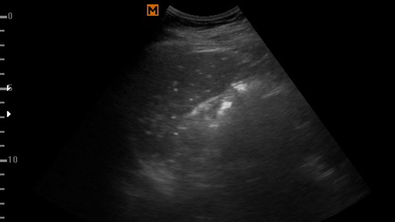 Splenic Granuloma || Ultrasound Cases 3 of 2000 - YouTube