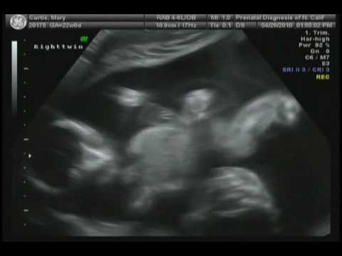 20 Weeks Pregnant With Twins Ultrasound