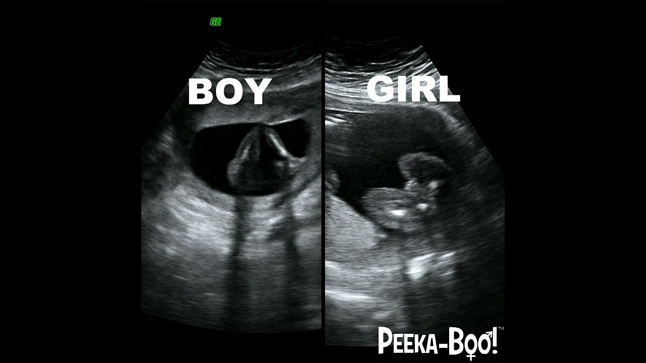 Baby Boy Gender Code On Ultrasound Report at Mary Le blog