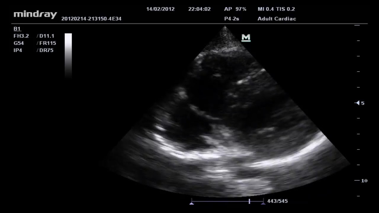 ultrasound heart video - YouTube