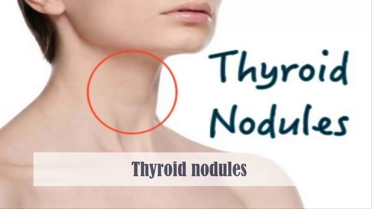 Thyroid Nodules Size Concern Chart