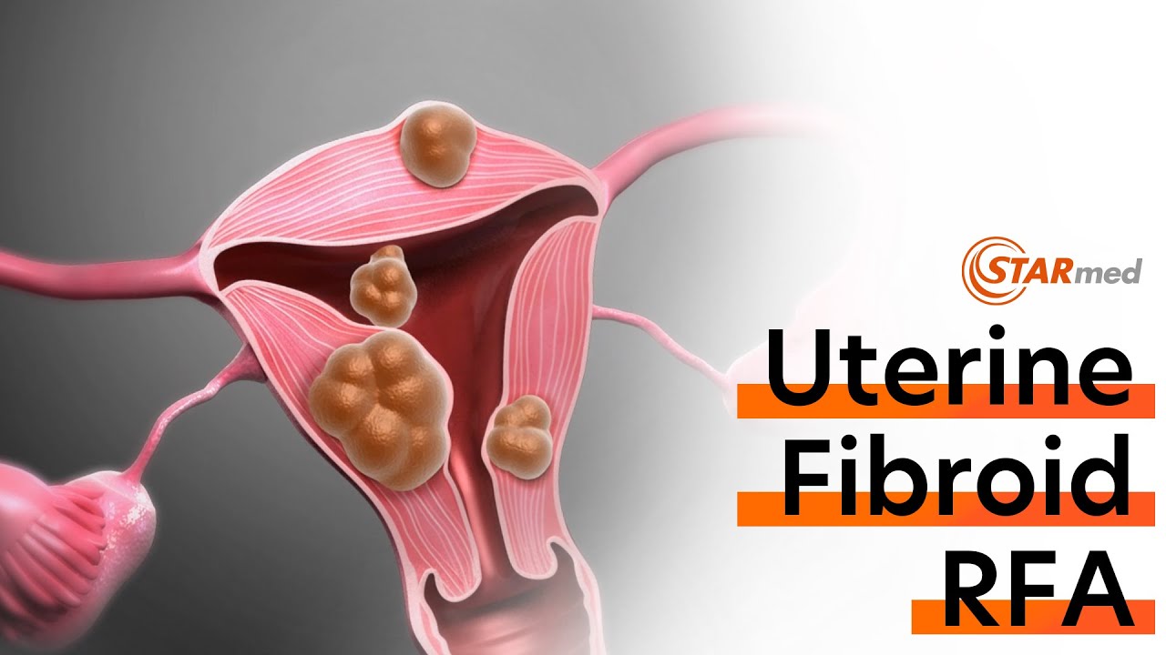 Uterine Fibroid Radiofrequency Ablation(RFA) Procedure - YouTube